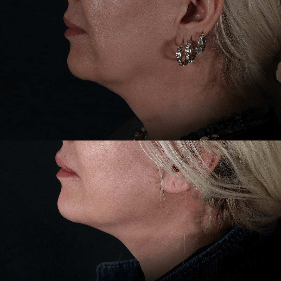 Chin Filler Before and After