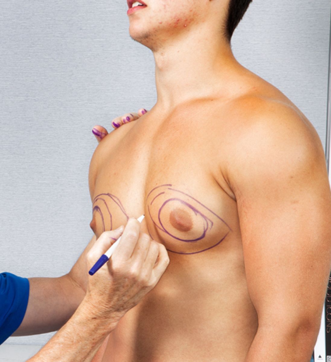 Gynecomastia