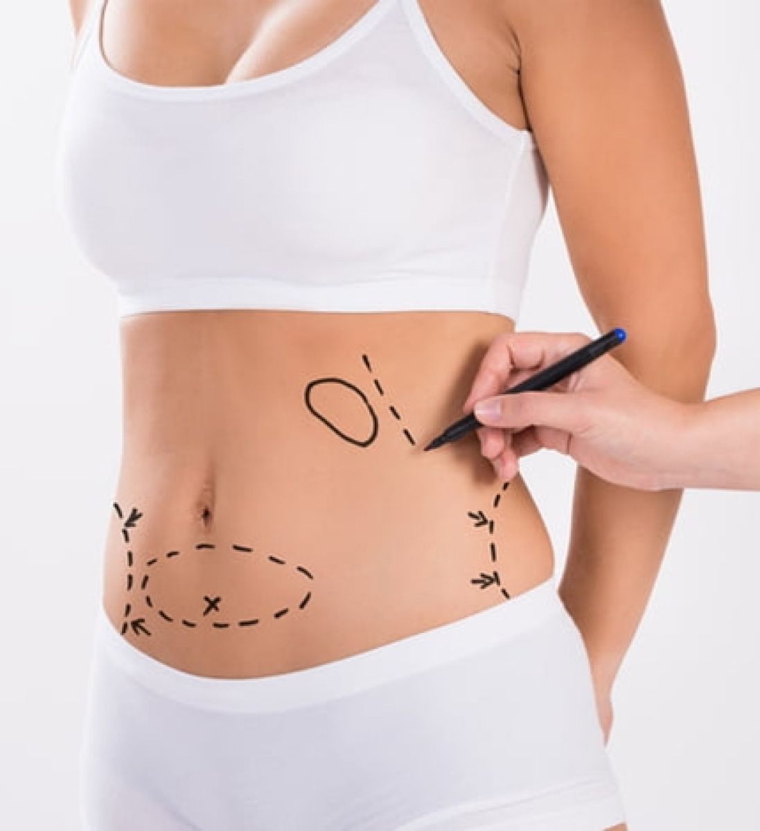 Tummy Tuck