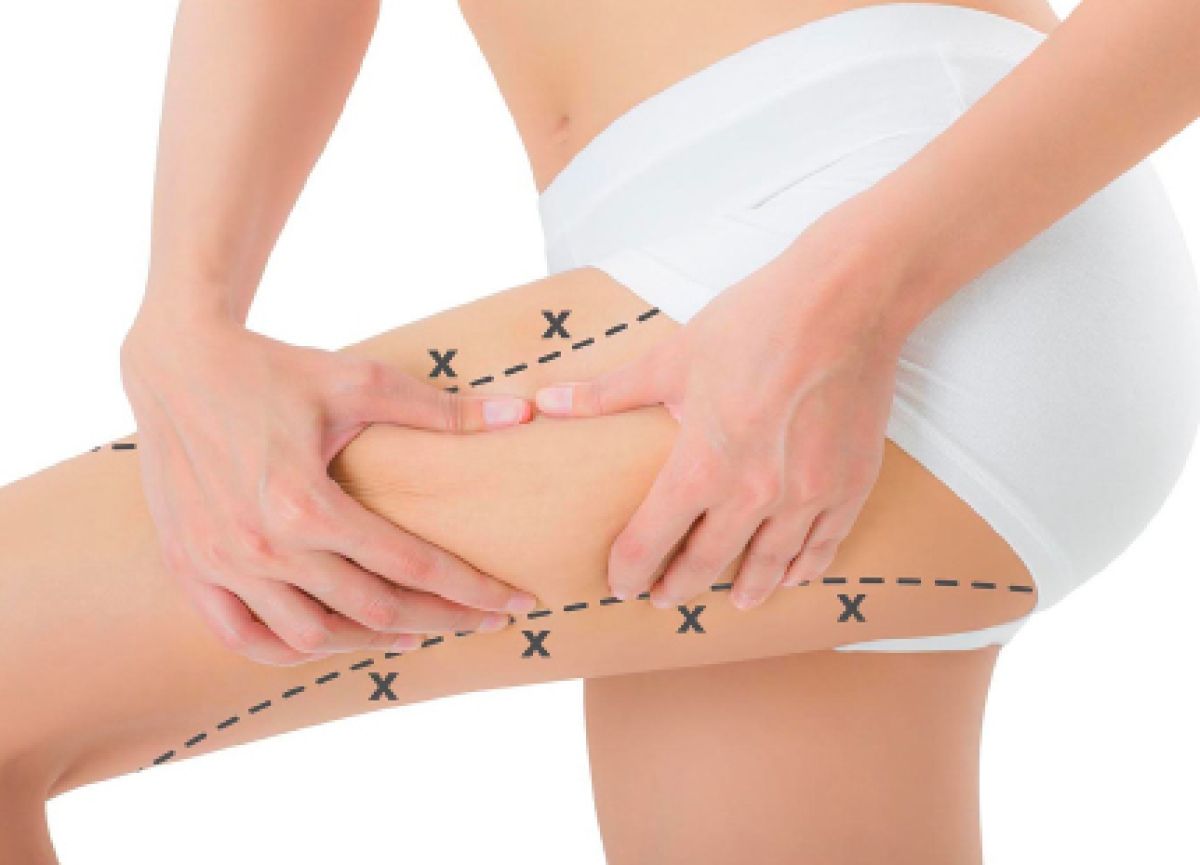 Lazer Liposuction Fiyatları