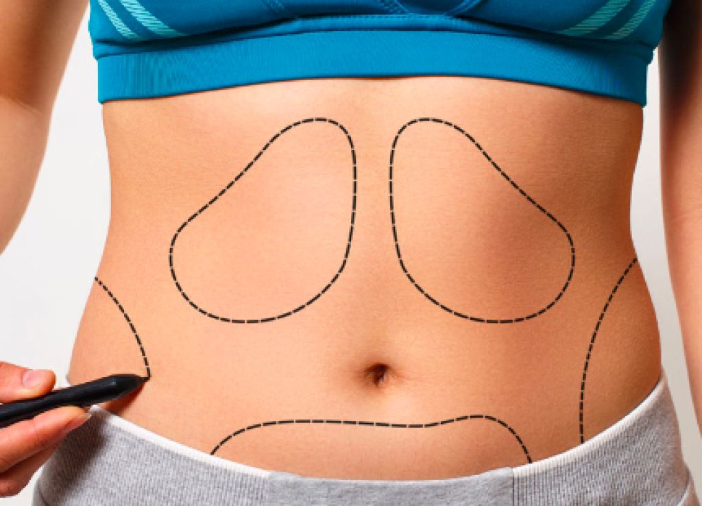 Liposuction Korsesi