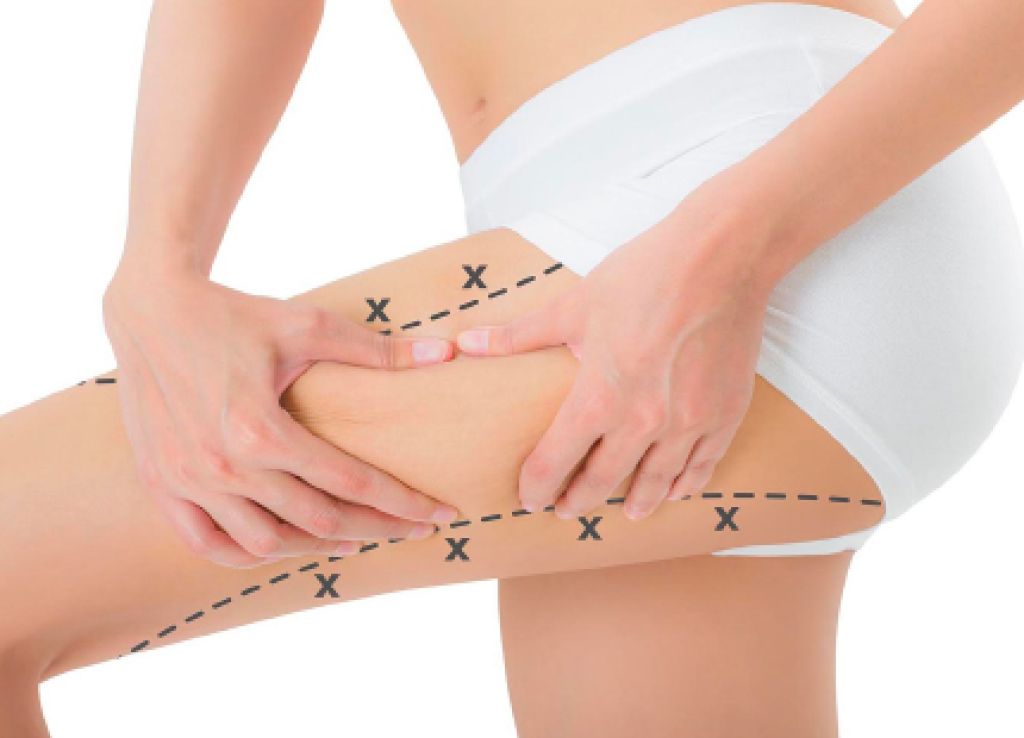 Liposuction Korsesi Nedir