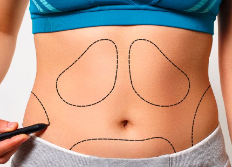 Liposuction Sonrası Yağlar Geri Gelir mi?